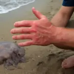 Cosa succede se tocchi una medusa spiaggiata? Effetti reali sulla pelle che pochi conoscono